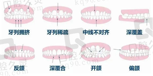北京牙齿矫正多少钱？