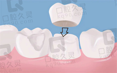 北京根管治疗/补牙/牙齿美白修复等收费价格表
