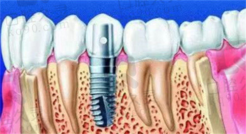 种植牙示意图