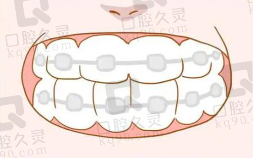 牙齿矫正