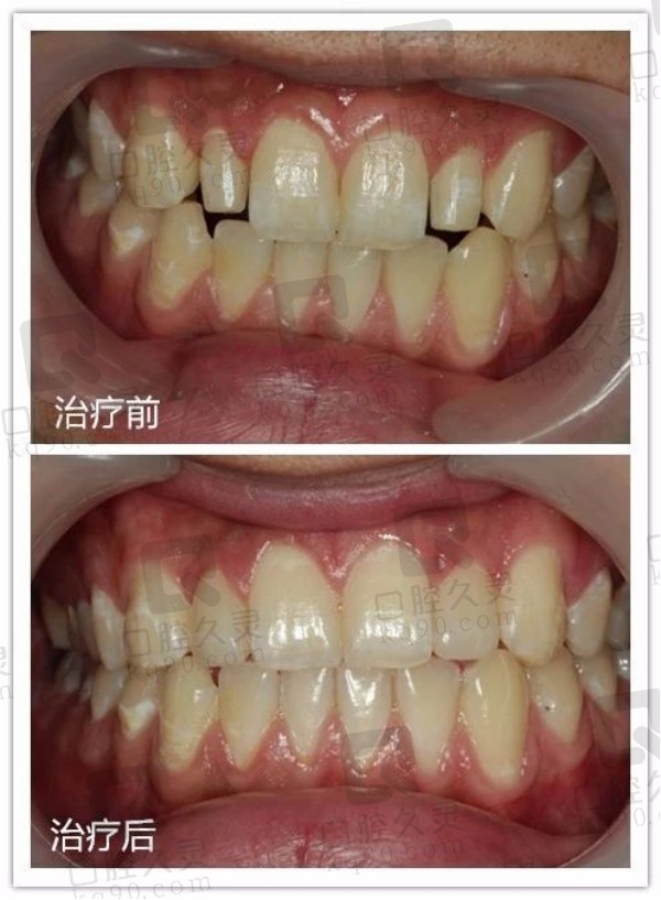 北京北区口腔矫正前后对比