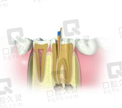 广州穗华口腔东圃院区根管治疗