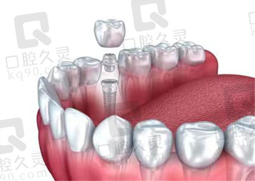 中山香山口腔医院单颗种植牙