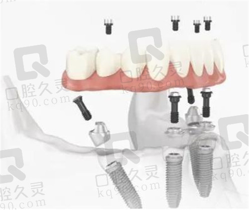 all-on-4全口种植牙
