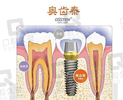 韩国奥齿泰种植牙