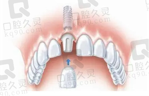 北京维恩口腔种植牙技术强