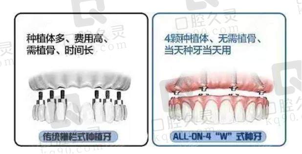 种植牙对比