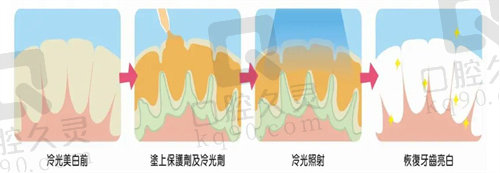 冷光美白过程