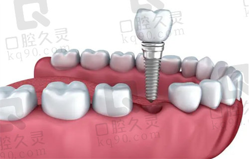 深圳种植牙便宜质量又好的牙科