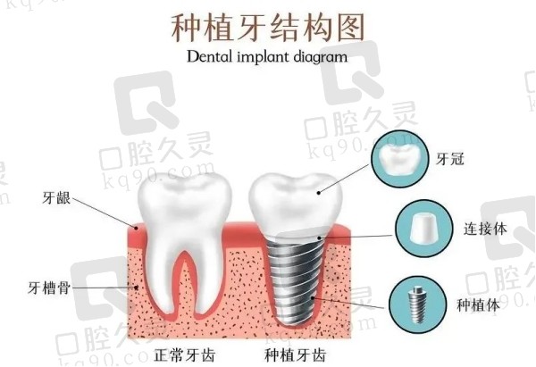 种植牙结构图