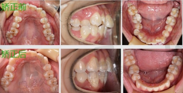 数字化正畸实例