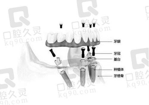 全口种植