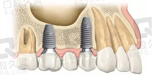 多颗种植牙