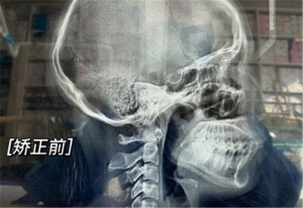北京康贝佳口腔牙齿矫正前CT图