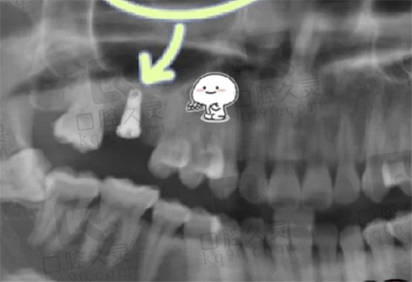 北京劲松口腔种植牙后CT照