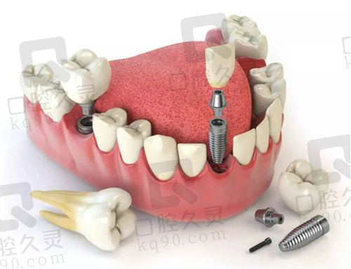 长沙牙祖口腔种植牙收费实惠