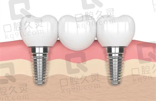 北京京通医院口腔科种植牙怎么样