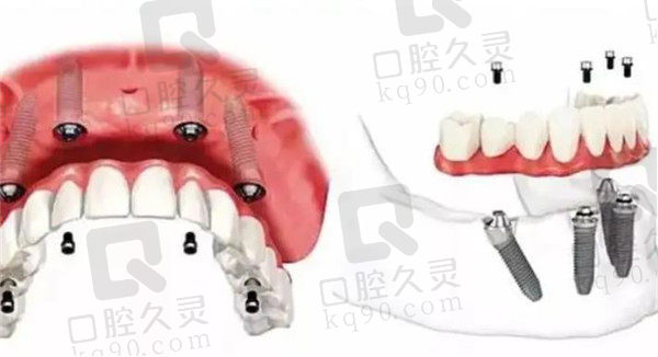 全固定种植牙
