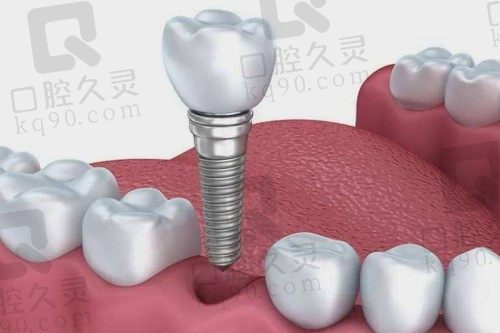 泰安种植牙多少钱、哪家好