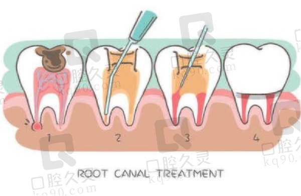 根管治疗