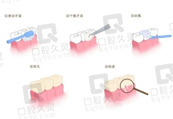 儿童口腔涂氟步骤