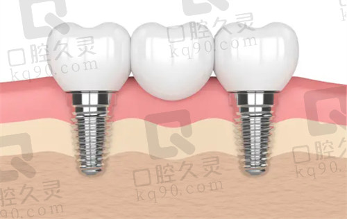 成都新桥口腔种植牙靠谱