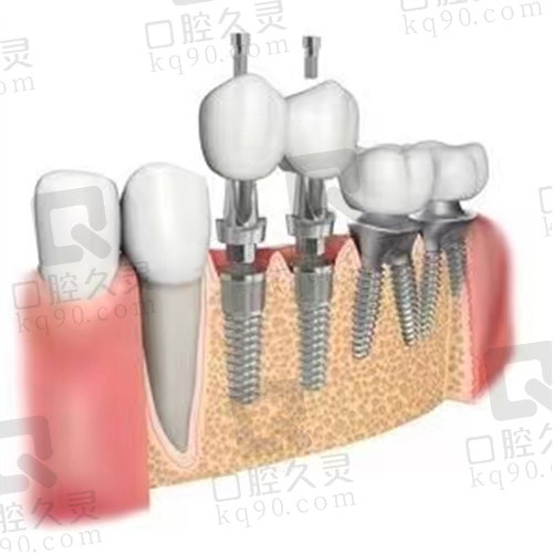 长沙优伢仕口腔种植牙