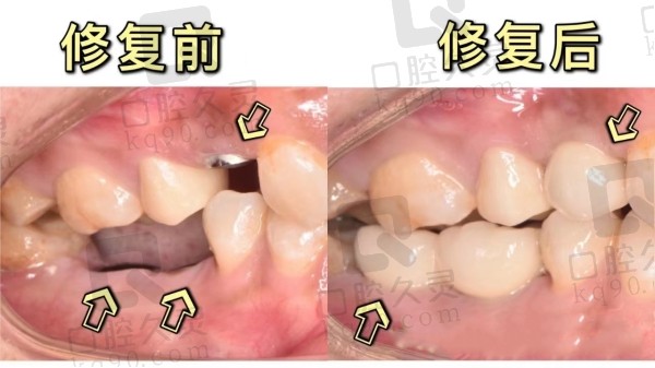 种植牙前后对比