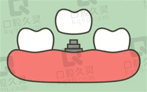 北京科尔口腔种植牙贵吗？