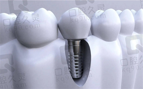 北京科尔口腔巩新科种植牙技术水平高