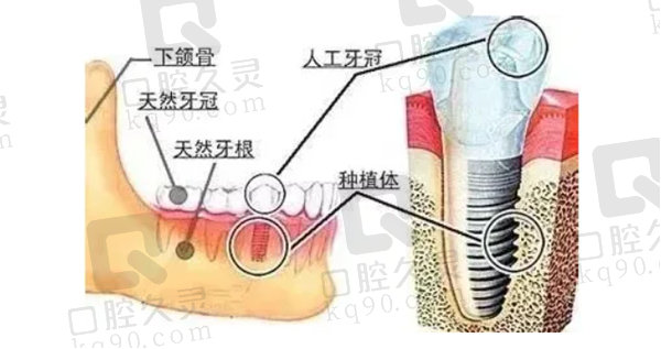 种植牙