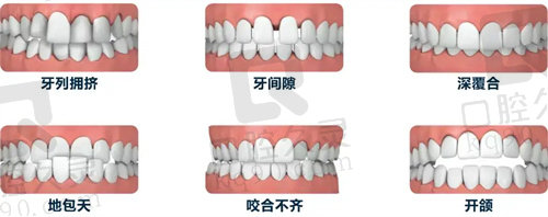 不同类型的错颌畸形