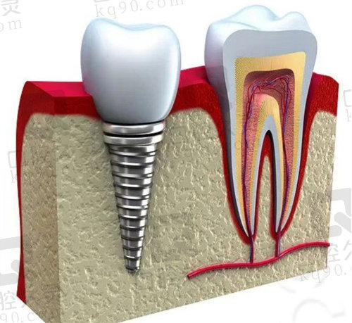 合肥新安口腔医院种植牙