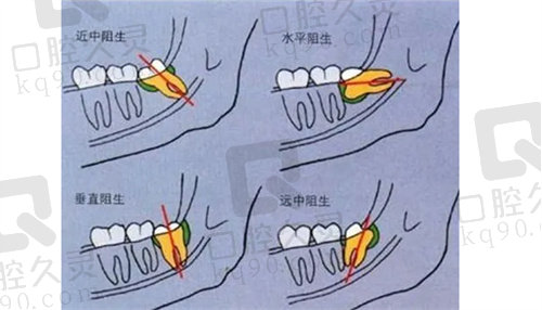 不同种类的阻生智齿