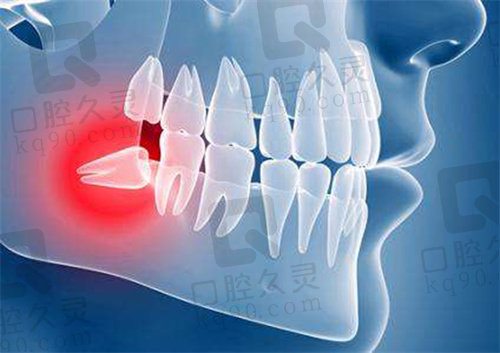 许多智齿不拔会频繁导致冠周炎