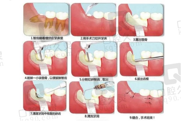 难拔智齿手术过程