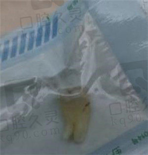 智齿拔掉