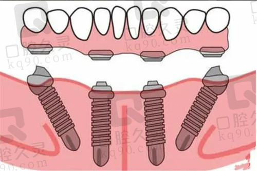 厦门麦芽口腔all-on-4种植技术娴熟