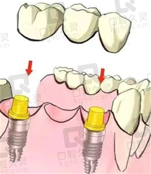 合肥大众口腔医院种植牙