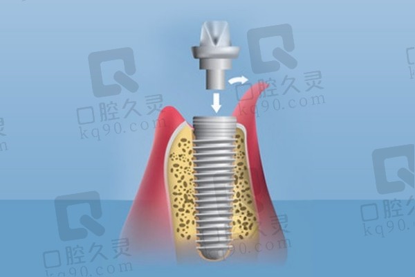 安装连接基台