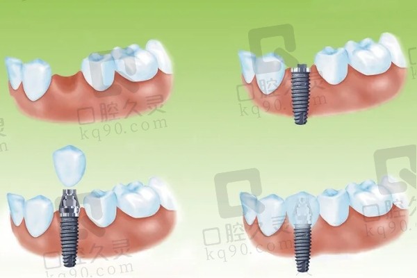 种植牙过程