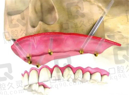 徐州鼎植口腔复杂种植牙技术优势