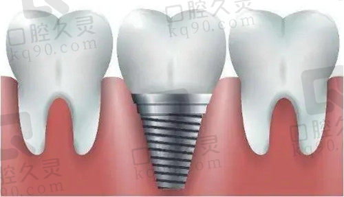 种植牙价格