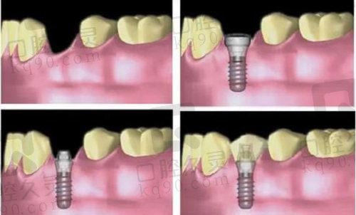种植牙示意图