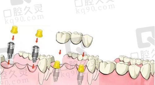 种植牙示意图