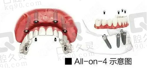 南京固德口腔种牙技术可靠吗？