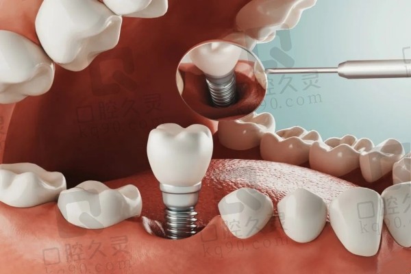 种植牙示意图