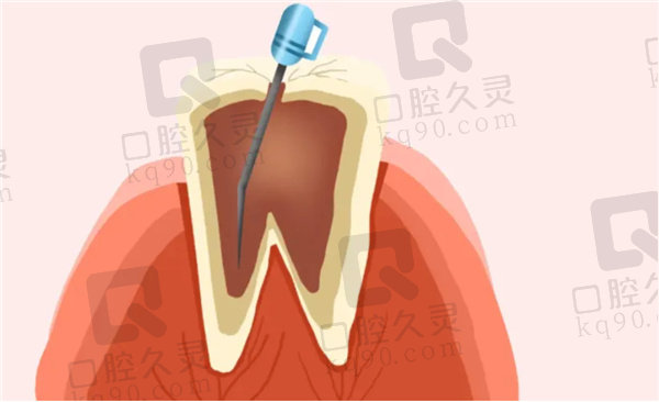 根管治疗