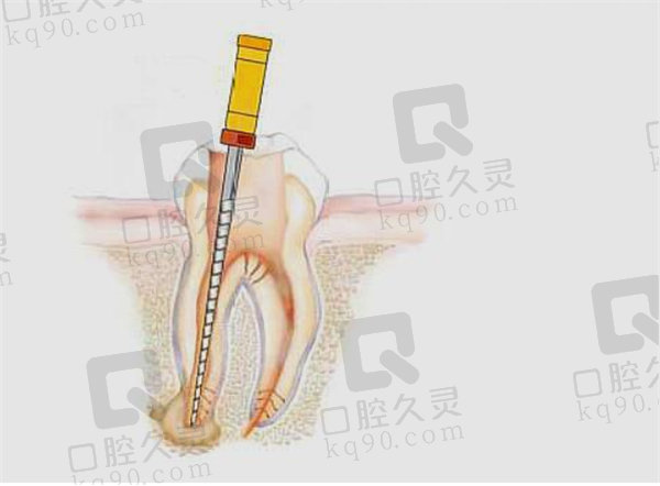 根管治疗