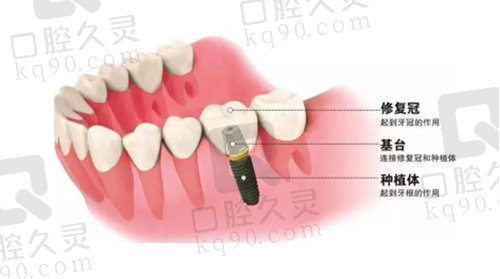 单颗种植牙分解图示